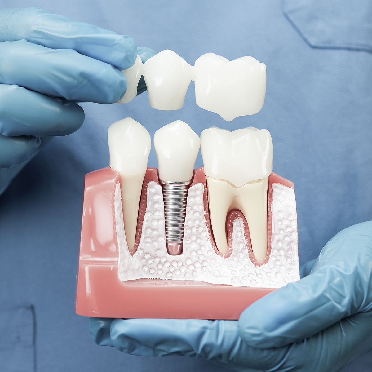 Dental Bridges vs Implants: Which Is the Right Choice for You?