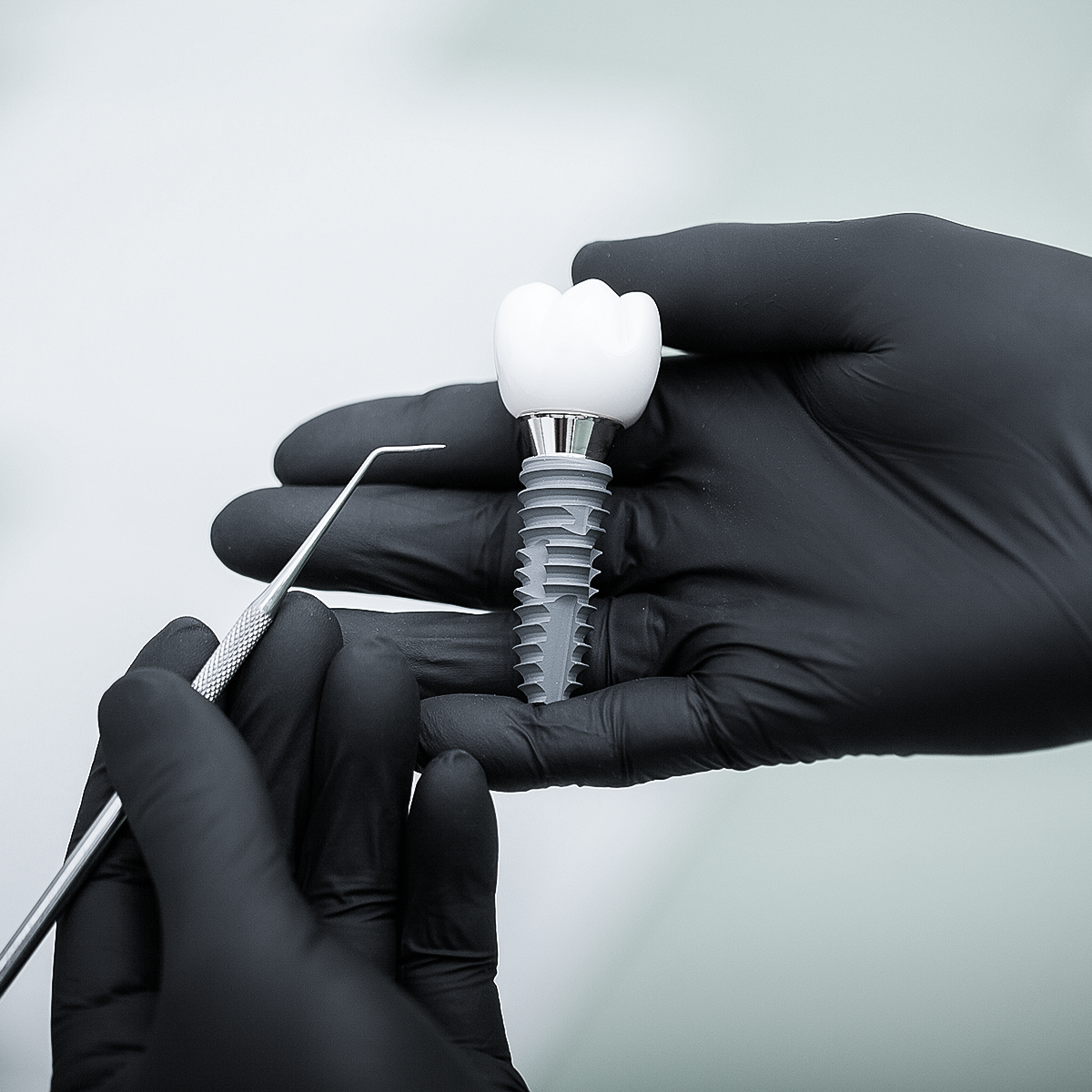 Dental Implants After Tooth Loss: Why Timing Matters