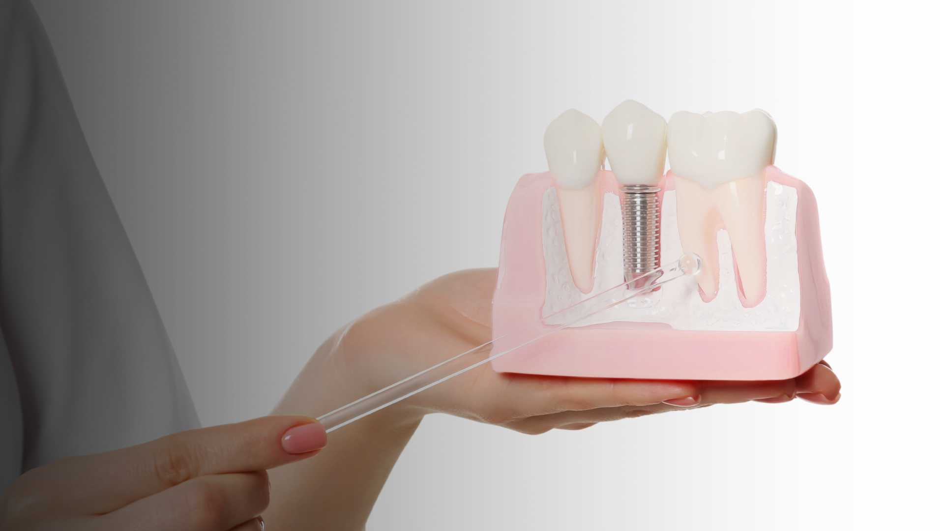 Dental Implants vs Dentures: Which Is Right for You?