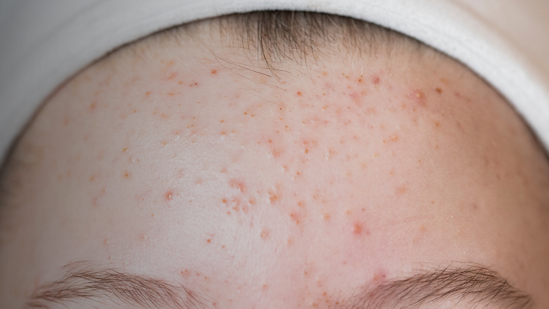 Acne Myths and Facts: What You Really Need to Know
