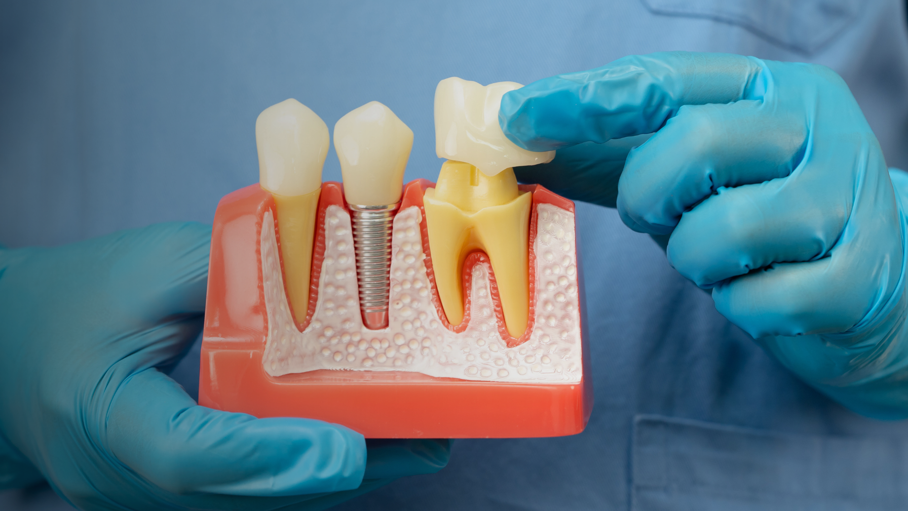 Do Dental Crowns Look Natural? The Key to a Seamless Smile