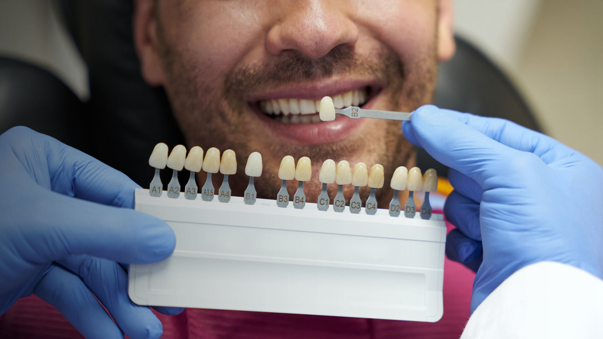 A Guide to Caring for Composite Veneers